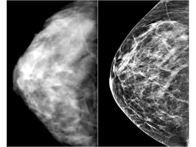 снимки маммография