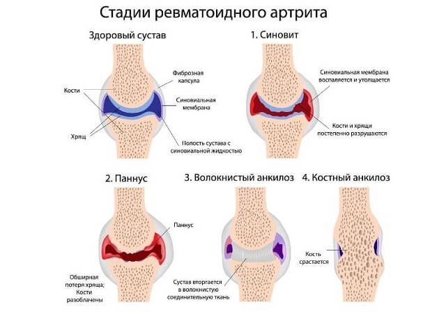 Стадии развития ревматоидного артрита