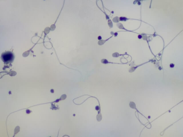 Эякулят под микроскопом в процессе исследования на фрагментацию ДНК сперматозоидов