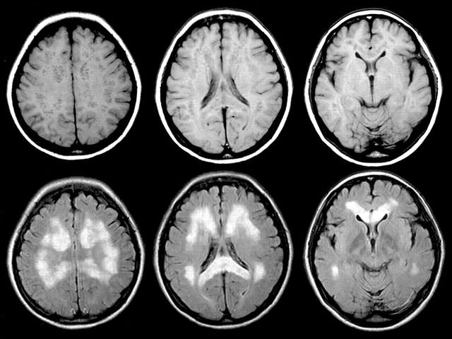 томография мозга