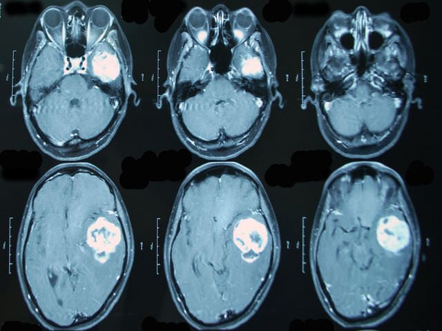 томография опухоли мозга 