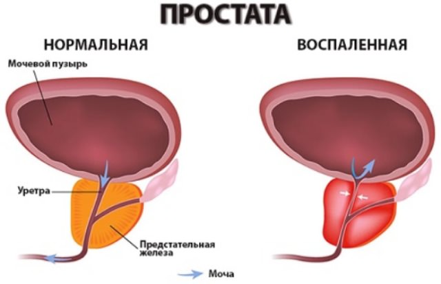 Воспаленная простата в сравнении с воспаленной