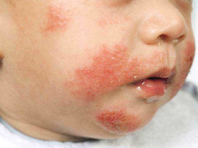 детская аллергия