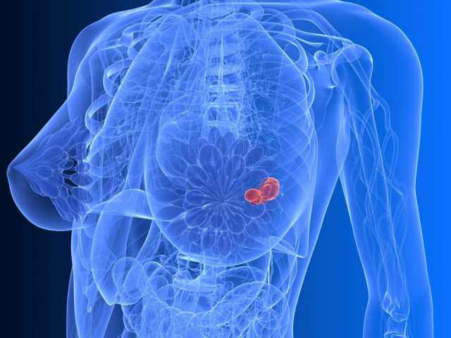 узи как диагностика рака груди
