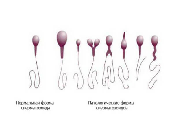 Норма и отклонения в строении сперматозоидов