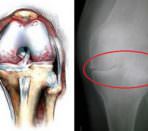 Заболевание колена