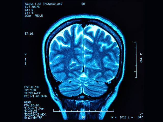 Снимок мозга